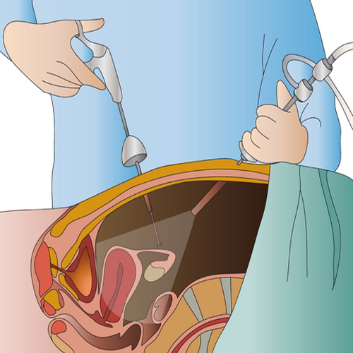 Laparoscopic Procedures